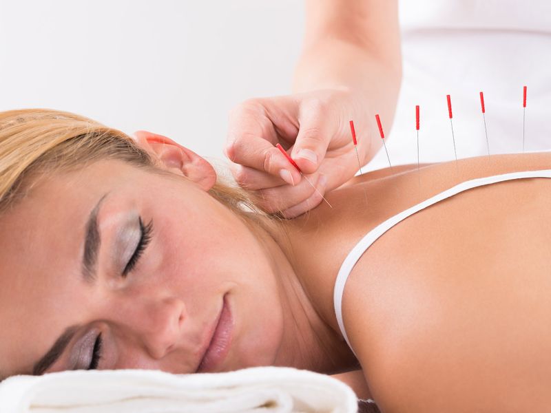 Akupunktur