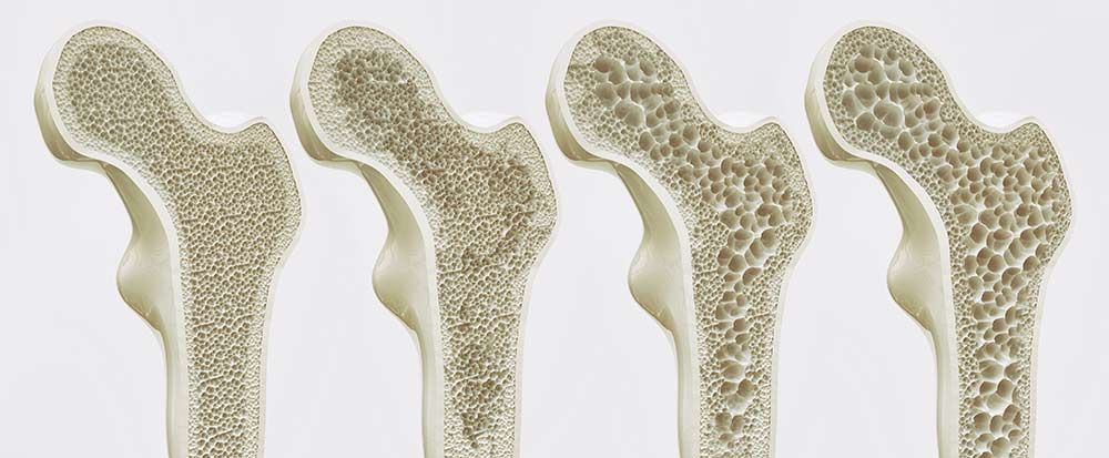 Osteoporose Therapie
