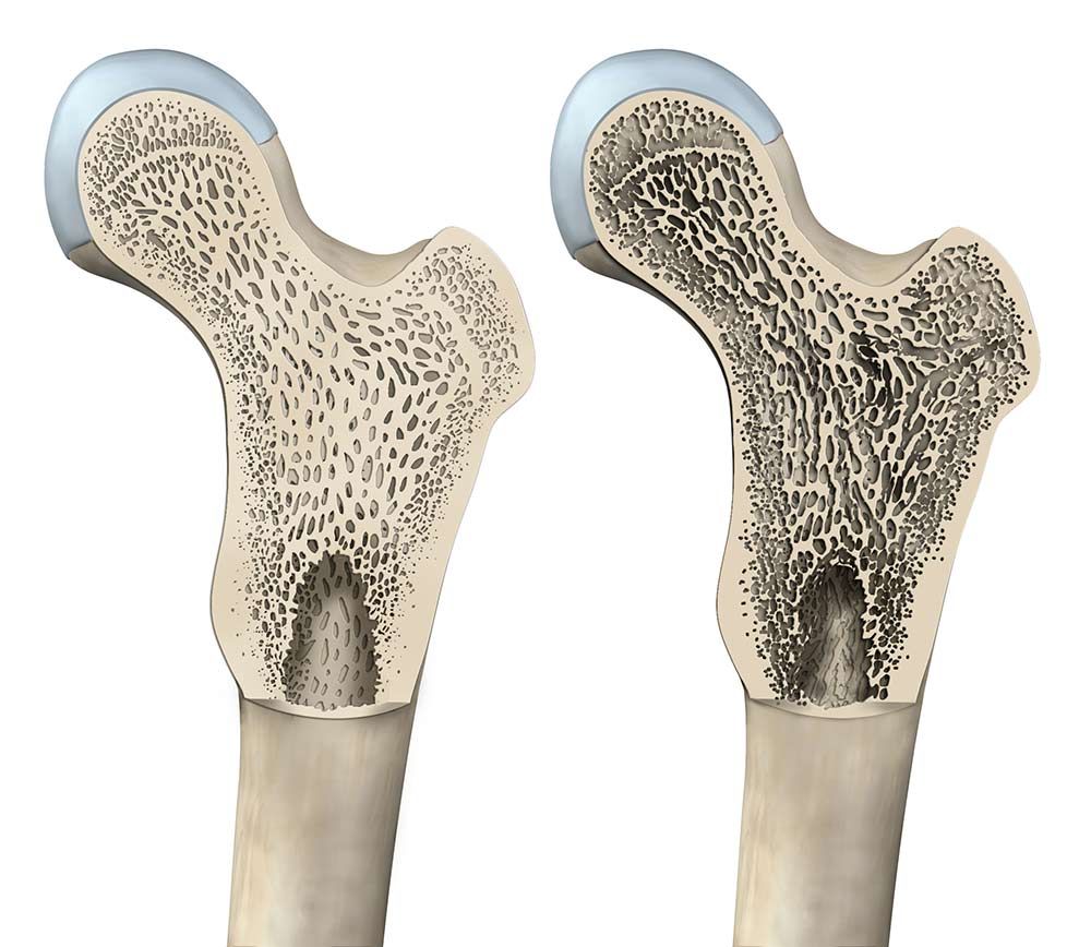 Osteoporose Therapie