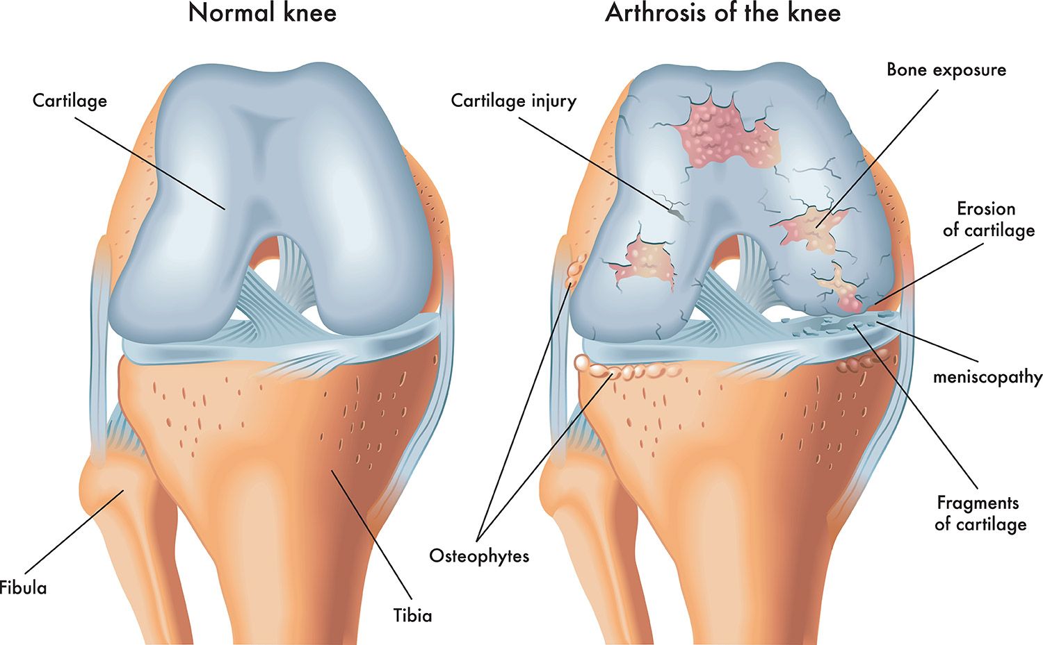 Arthrosetherapie