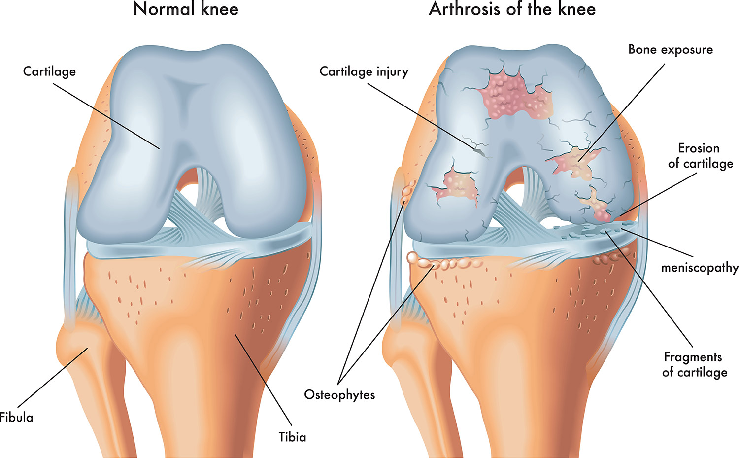 Arthrosetherapie