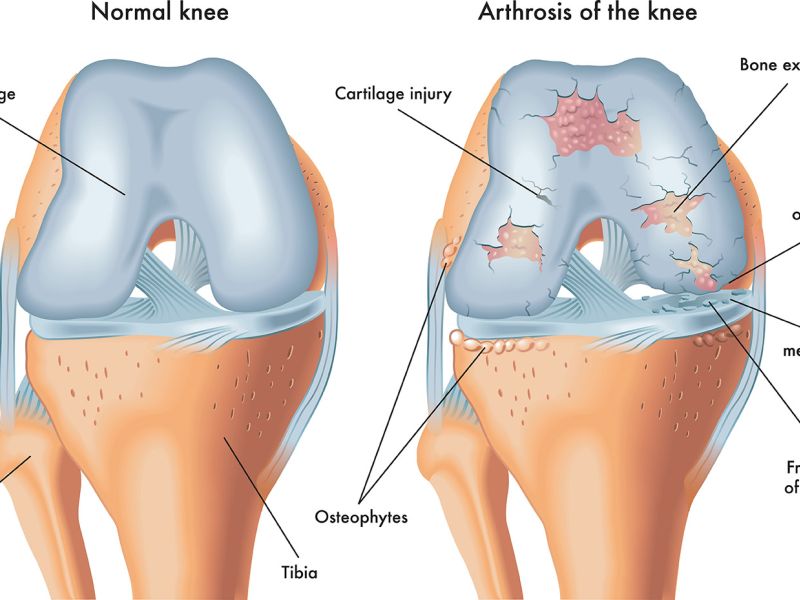 Arthrosetherapie